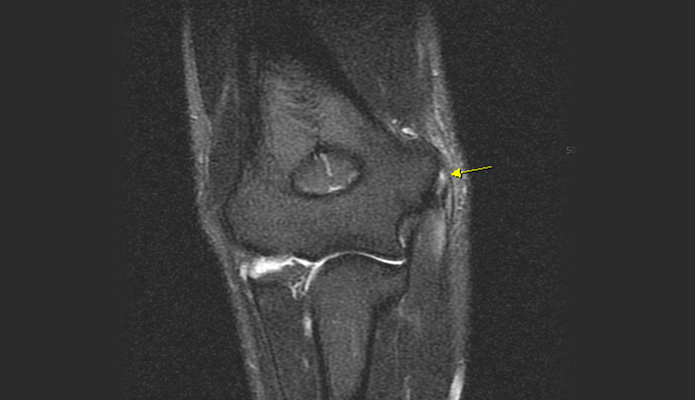 팔꿈치 수술 전 MRI