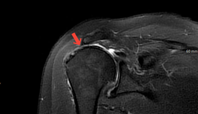 역행성 인공관절 치환술 수술 전 MRI