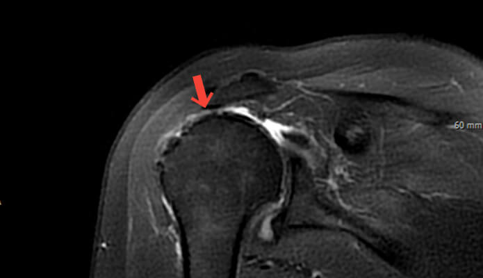 역행성 인공관절 치환술 수술 전 MRI