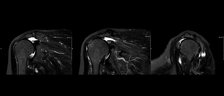 역행성 인공관절 치환술 수술 전 MRI