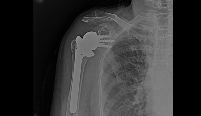 역행성 인공관절 치환술 후 X-RAY