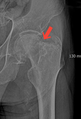 대퇴경부 골절 인공관절 치환술 수술 전 X-ray