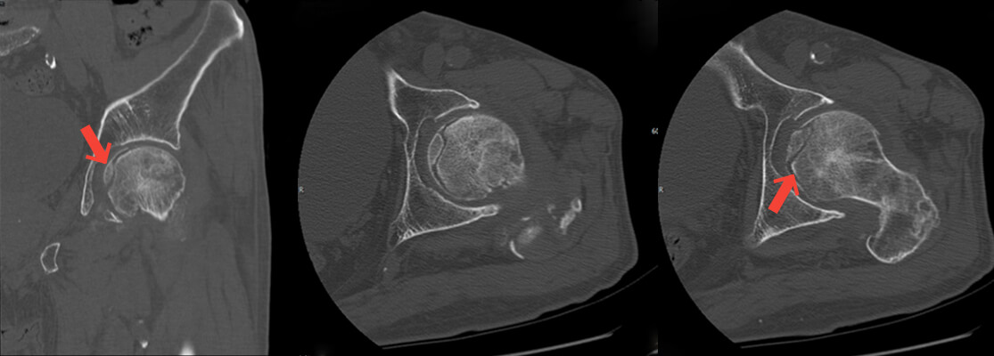 대퇴경부 골절 인공관절 치환술 수술 전 X-ray