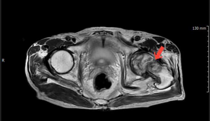 대퇴경부 골절 인공관절 치환술 수술 전 MRI