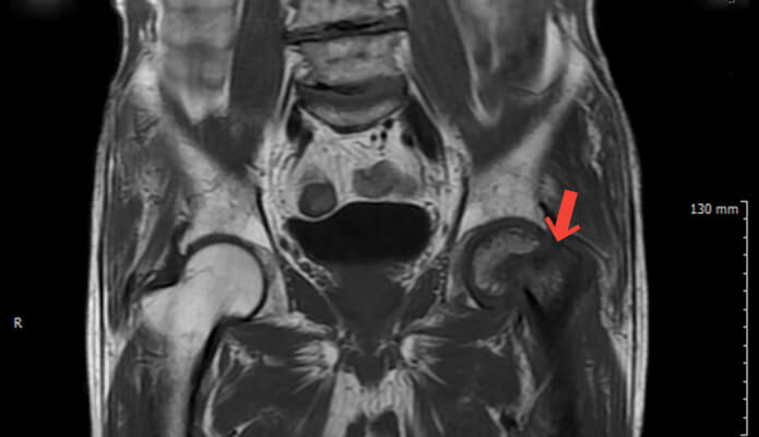 대퇴경부 골절 인공관절 치환술 수술 전 MRI