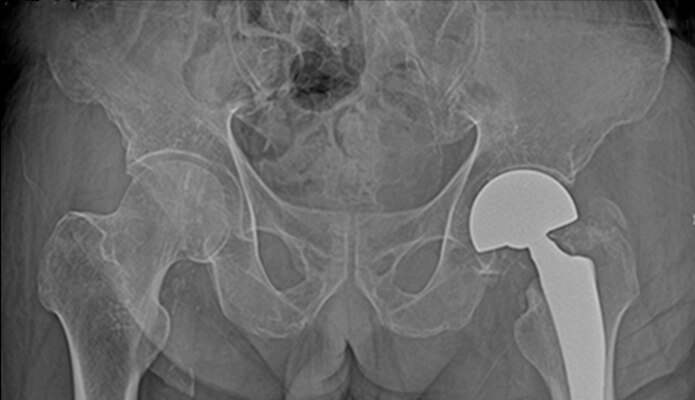 대퇴경부 골절 인공관절 치환술 수술 후 X-RAY