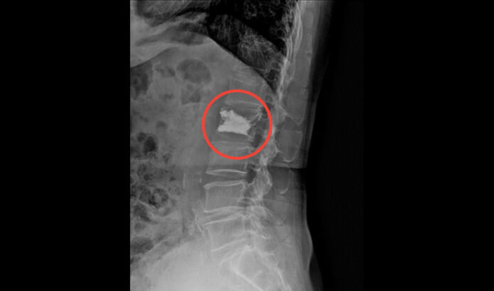 골시멘트를 이용한 척추체 성형술 후